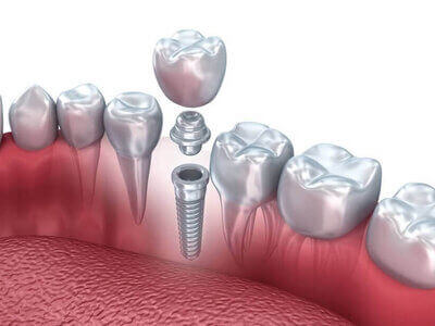 IMPLANT - ATAMNABUJARAN - ATAMNABUJARANNER